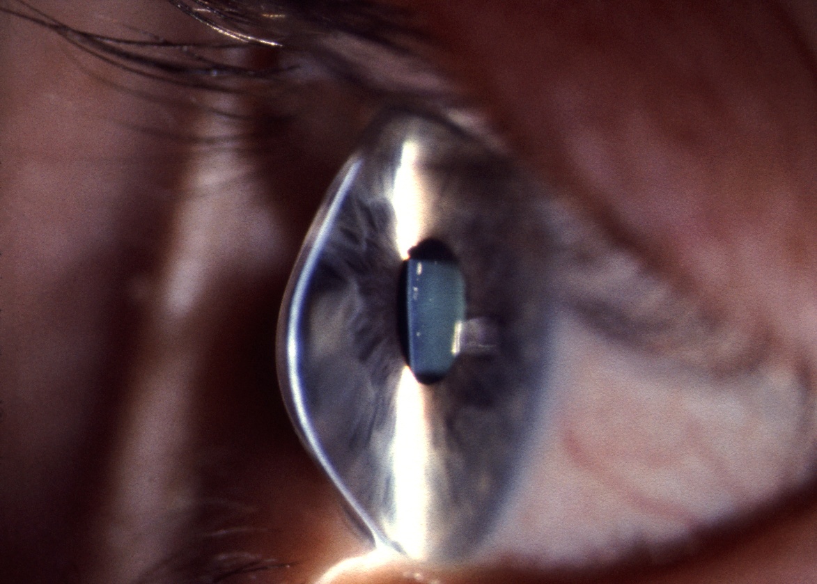 https://www.eyebizz.de/app/uploads/2020/02/BVA-therapeutische-Kontaktlinsen-beginnender-Keratokonus.jpg