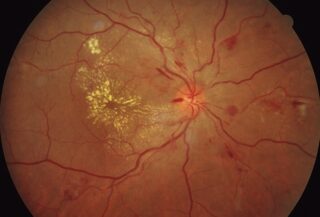 BVA Bluthochdruck Schäden Netzhaut Augenhintergrund