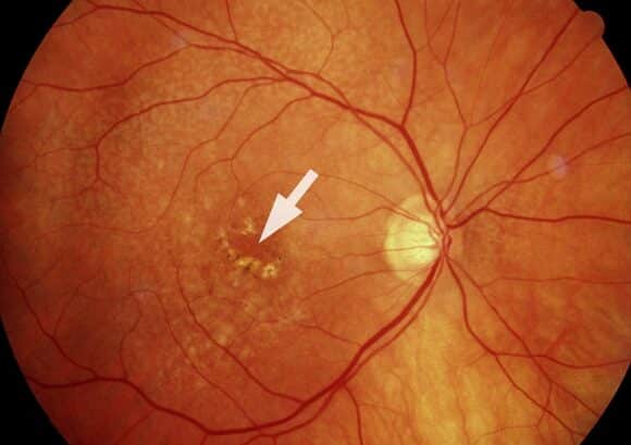 Altersabhängige Makuladegeneration AMD c BVA