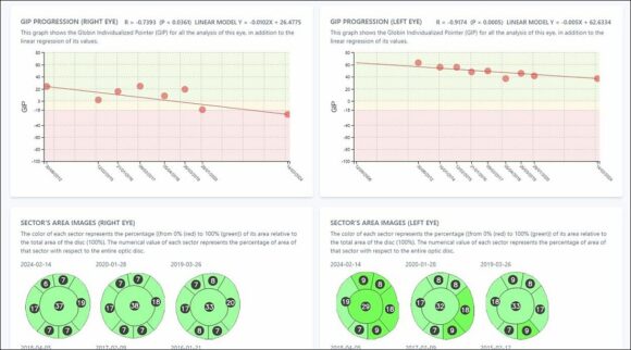 RetinaLyze Glaucoma Index of Progression GIP Advanced-Glaucoma