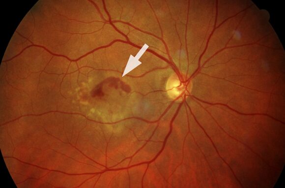 Feuchte Form der Altersabhängigen Makuladegeneration AMD c BVA