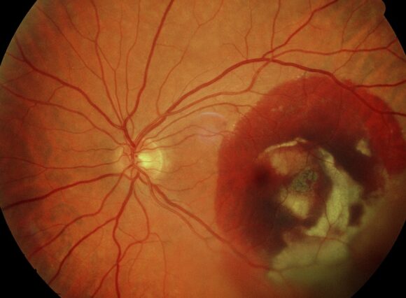 Fortgeschrittene feuchte Altersabhängige Makuladegeneration AMD c BVA